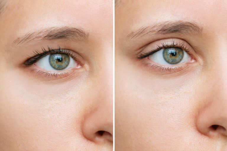 Blefaroplastia superior